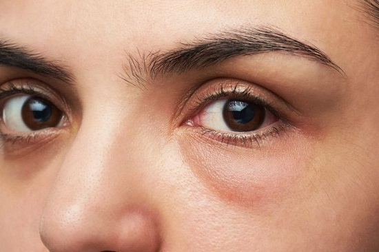 Best Eye Gel for Puffy Eyes